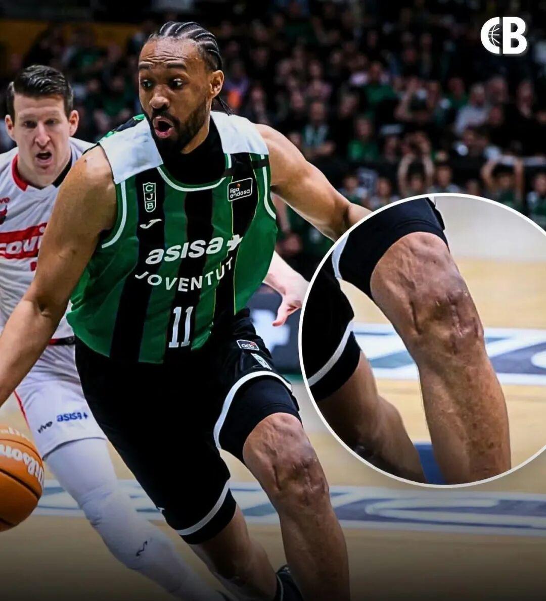 蓝鲸体育官网入口-好可怕的膝盖！两次ACL撕裂，他还在打球！！！